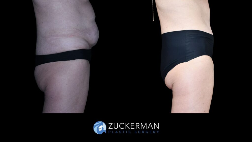 Patient results from Mommy Makeover performed by Dr. Zuckerman, showing tummy tuck results and a flatter, more toned abdominal area, right view.
