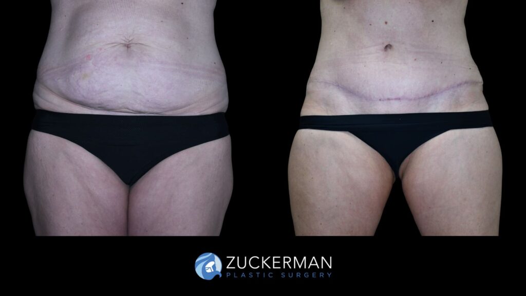 Patient results from Mommy Makeover performed by Dr. Zuckerman, showing tummy tuck results and a flatter, more toned abdominal area, front view.