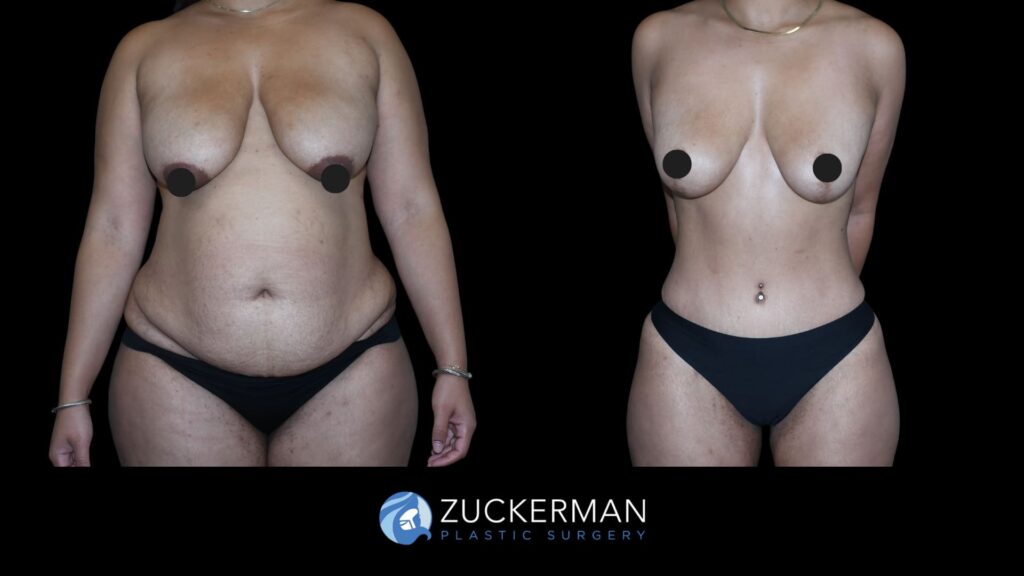 Patient results before and after Mommy Makeover performed by Dr. Zuckerman, including tummy tuck and a mild breast lift, showing improved abdominal contour and subtly lifted breasts, front view.