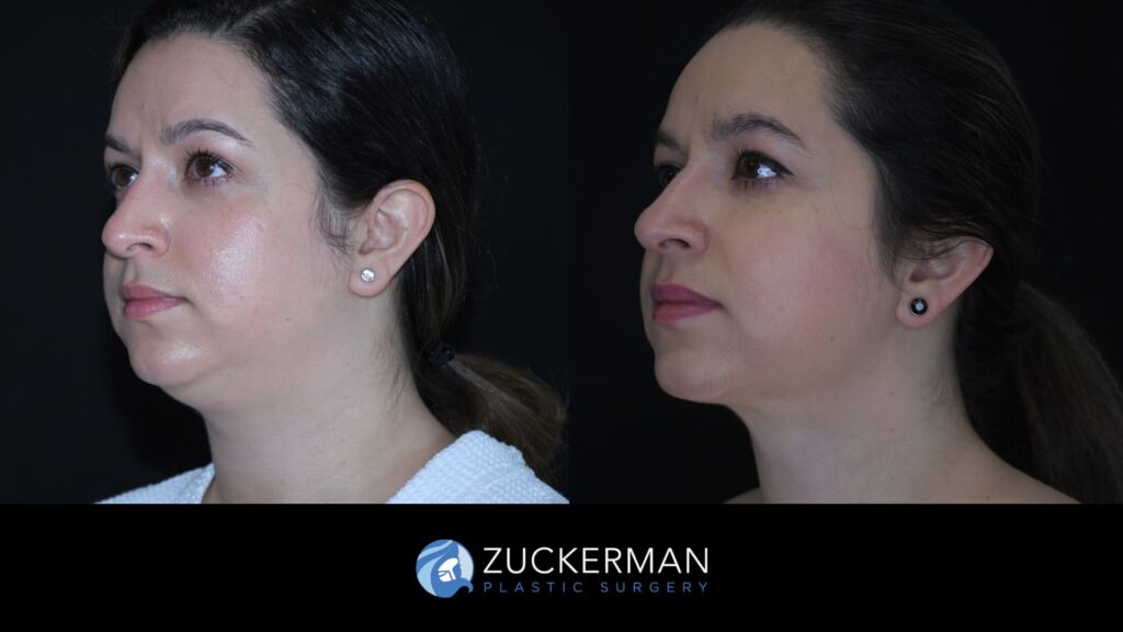 Patient results before and after submental liposuction performed by Dr. Zuckerman, showing improved contour of the chin and neck area, left oblique view.