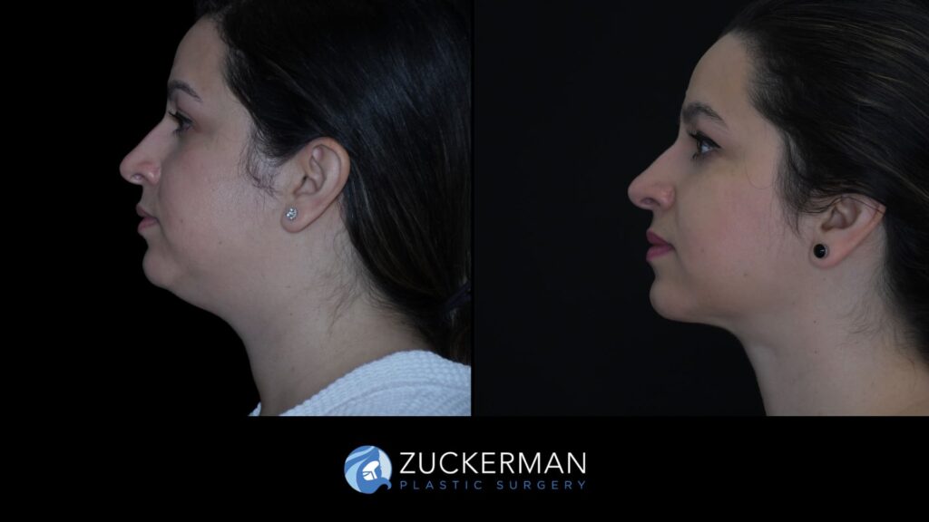 Patient results before and after submental liposuction performed by Dr. Zuckerman, showing improved contour of the chin and neck area, left view.