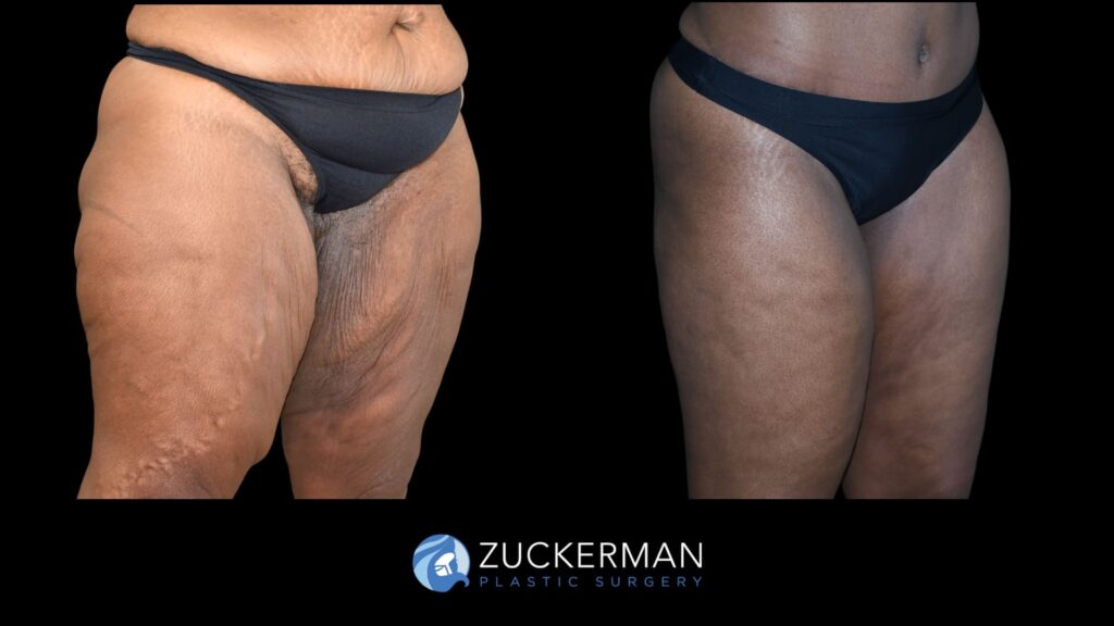 Patient results before and after thigh lift performed by Dr. Zuckerman, showing improved contour and tightening of the thighs, right oblique view.