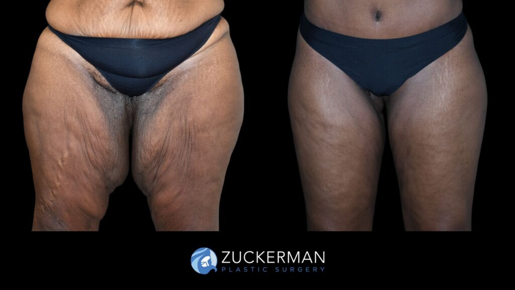 Patient results before and after thigh lift performed by Dr. Zuckerman, showing improved contour and tightening of the thighs, front view.
