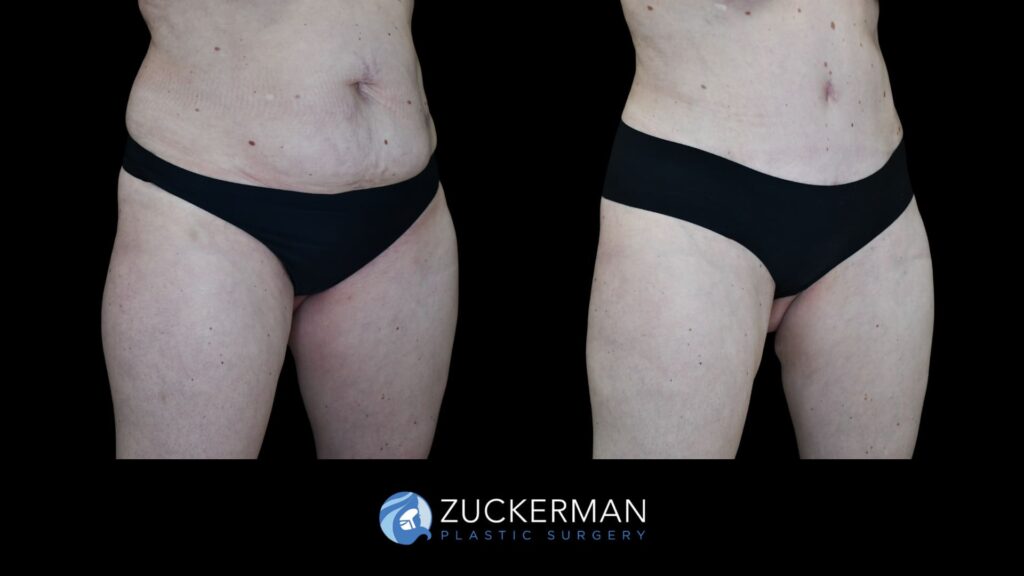 Patient results before and after tummy tuck performed by Dr. Zuckerman, showing a flatter and more toned abdominal area, right oblique view.