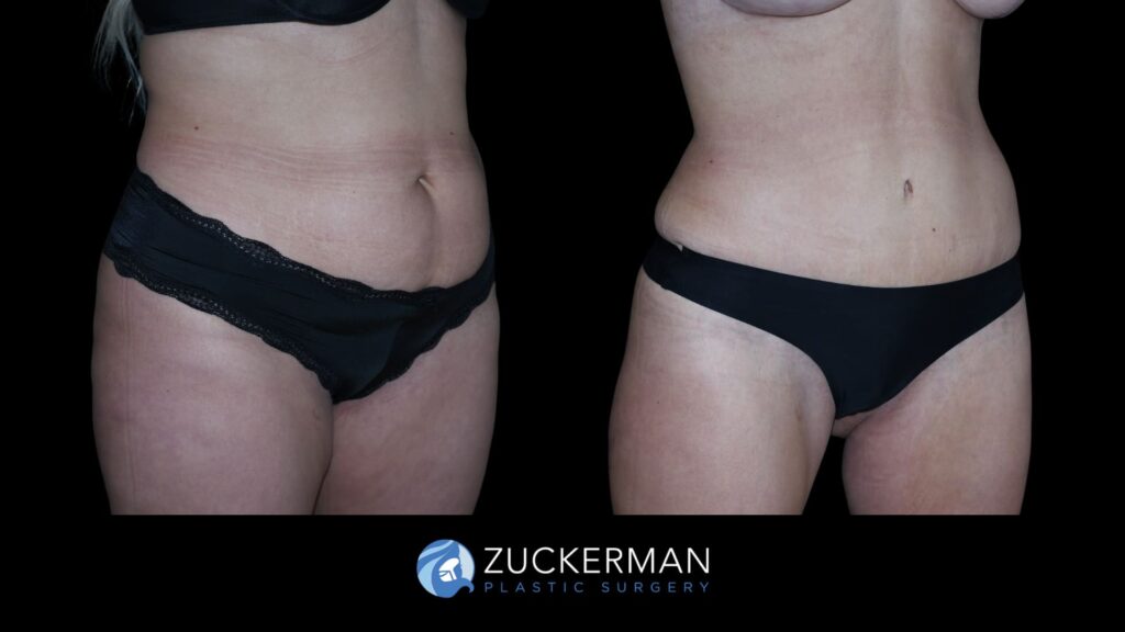 Patient results before and after tummy tuck performed by Dr. Zuckerman, showing a flatter and more toned abdominal area, right oblique view.