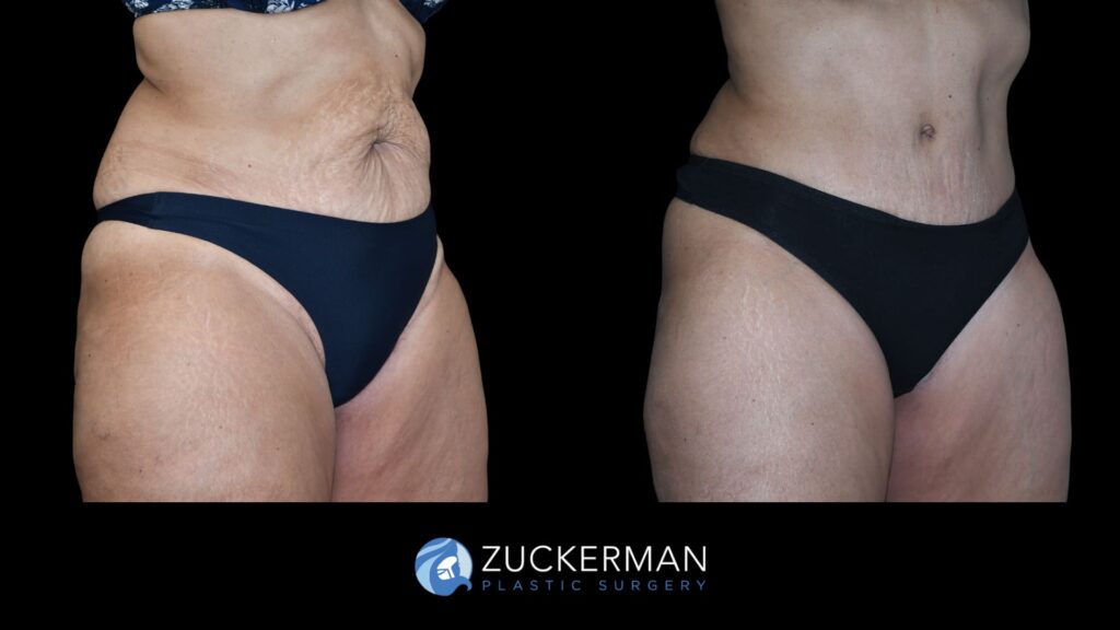 Patient results before and after tummy tuck performed by Dr. Zuckerman, showing a flatter and smoother abdominal area, right oblique view.