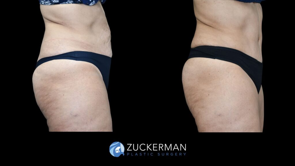 Patient results before and after tummy tuck performed by Dr. Zuckerman, showing a flatter and smoother abdominal area, right view.