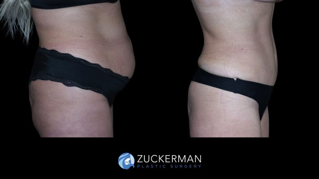Patient results before and after tummy tuck performed by Dr. Zuckerman, showing a flatter and more toned abdominal area, right view.