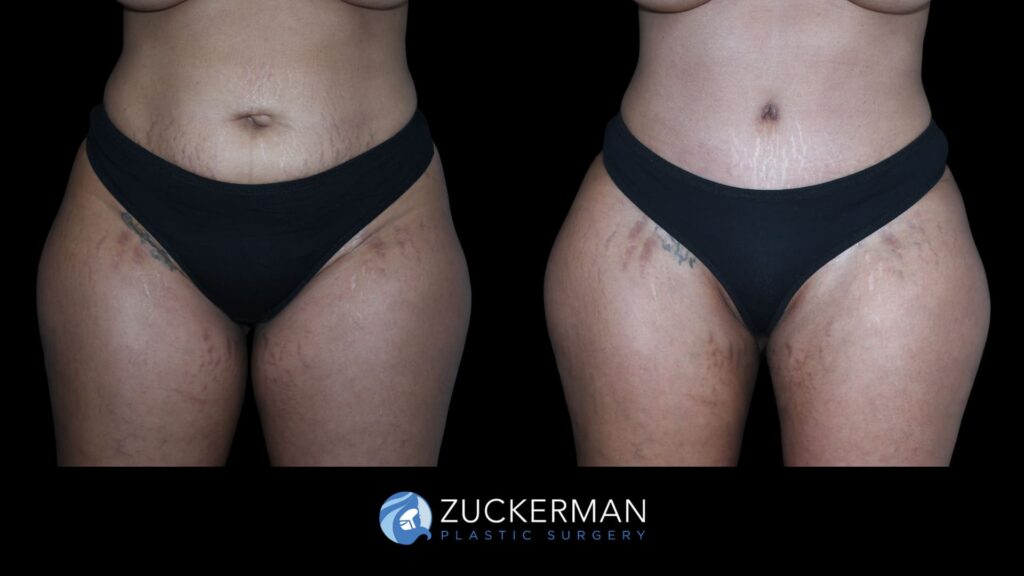Patient results before and after tummy tuck performed by Dr. Zuckerman, showing a flatter and more toned abdominal area, front view.