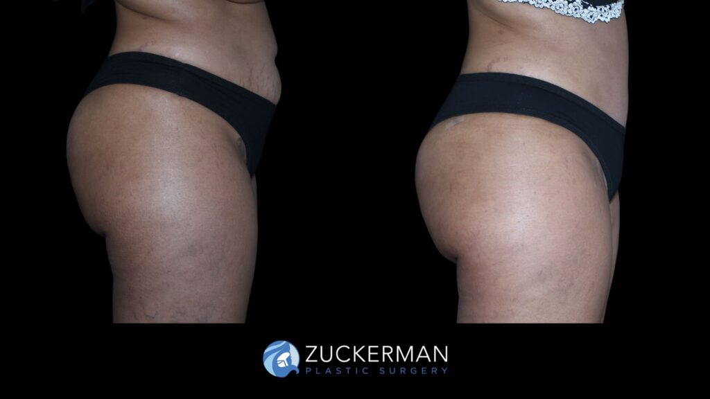 Patient results before and after tummy tuck performed by Dr. Zuckerman, showing a flatter and more toned abdominal area, right view.