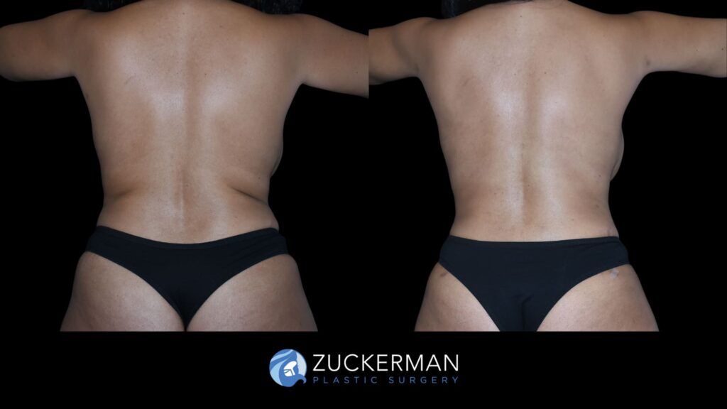 Patient results before and after back liposuction performed by Dr. Zuckerman, showing improved contour and reduction of excess fat in the back area.