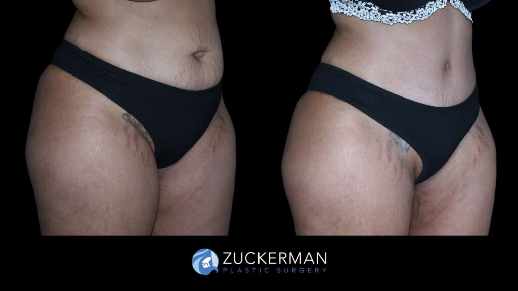 Patient results before and after tummy tuck performed by Dr. Zuckerman, showing a flatter and more toned abdominal area, right oblique view.