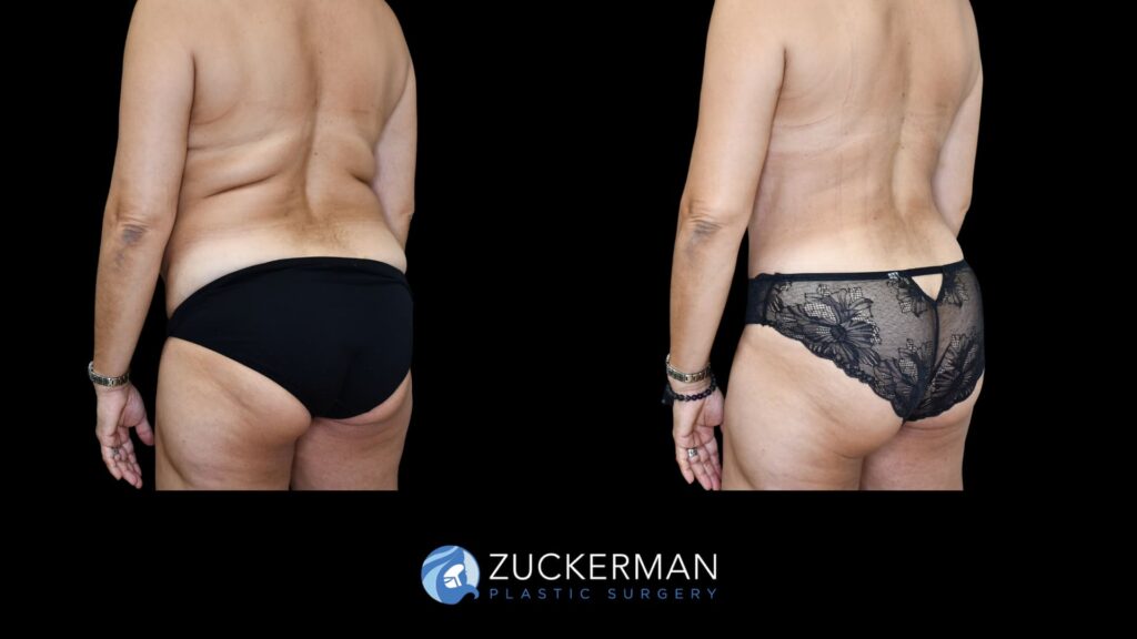 Before and after tummy tuck and back liposuction performed by Dr. Zuckerman, showing improved contour of the abdomen and back, right oblique back view.