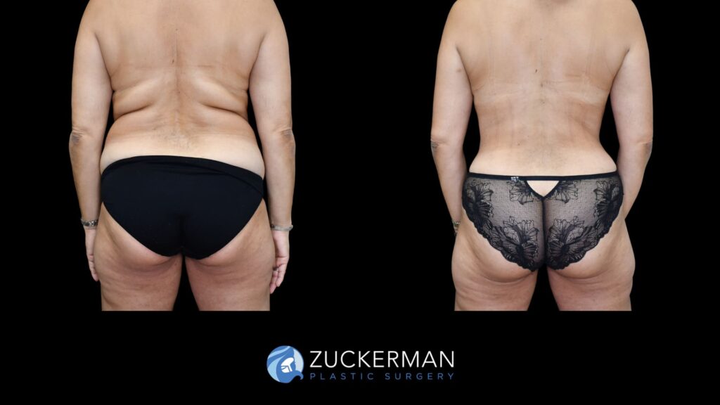 Before and after tummy tuck and back liposuction performed by Dr. Zuckerman, showing improved contour of the abdomen and back, back view.