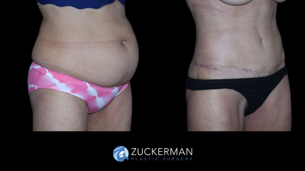 Patient results before and after tummy tuck and back lift performed by Dr. Zuckerman, right oblique view.