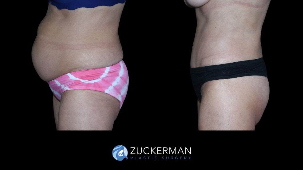 Patient results before and after tummy tuck and back lift performed by Dr. Zuckerman, left view.