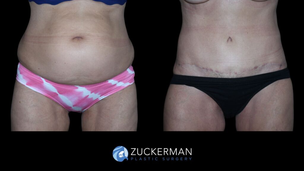 Patient results before and after tummy tuck and back lift performed by Dr. Zuckerman, front view.