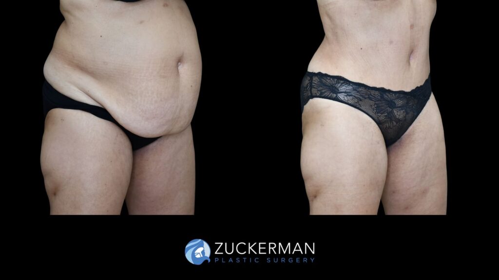 Before and after tummy tuck and back liposuction performed by Dr. Zuckerman, showing improved contour of the abdomen and back, right oblique view.