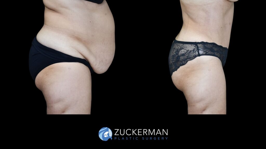 Before and after tummy tuck and back liposuction performed by Dr. Zuckerman, showing improved contour of the abdomen and back, right view.