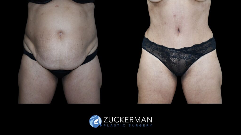 Before and after tummy tuck and back liposuction performed by Dr. Zuckerman, showing improved contour of the abdomen and back, front view.