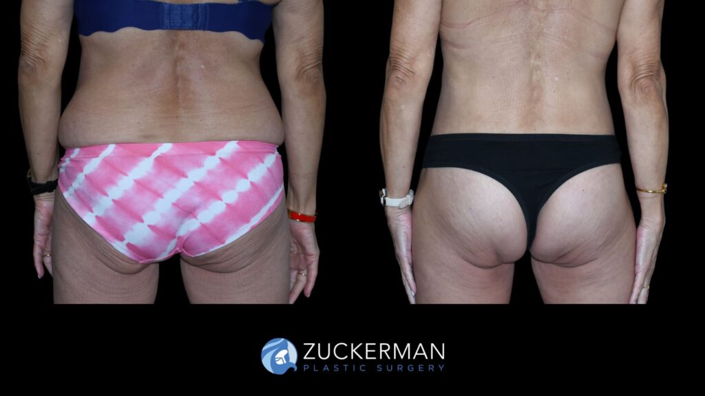 Patient results before and after tummy tuck and back lift performed by Dr. Zuckerman, back view.