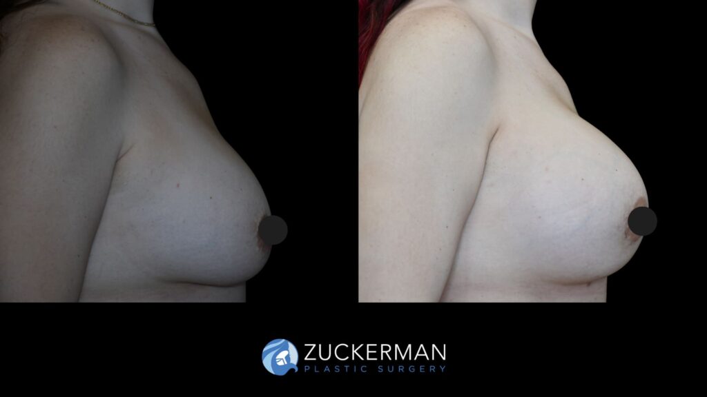 Patient results before and after breast augmentation performed by Dr. Zuckerman, showing enhanced breast shape and volume, right view.
