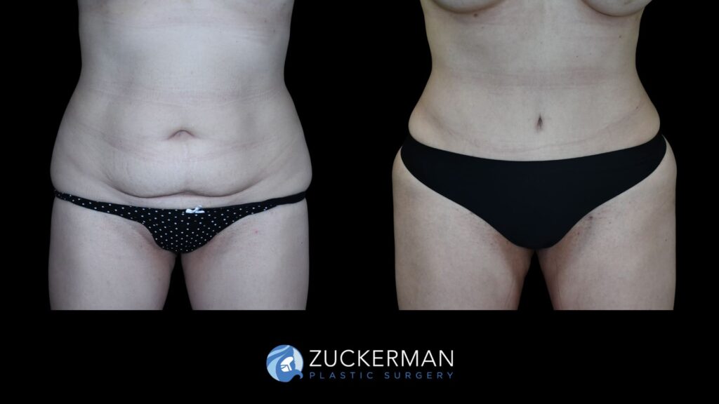 Patient results before and after tummy tuck performed by Dr. Zuckerman, showing a flatter and more toned abdominal area, front view.