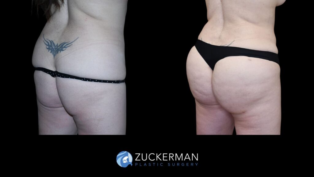 Patient results before and after Brazilian Butt Lift (BBL) performed by Dr. Zuckerman, showing improved contour and volume of the buttocks, right oblique back view.