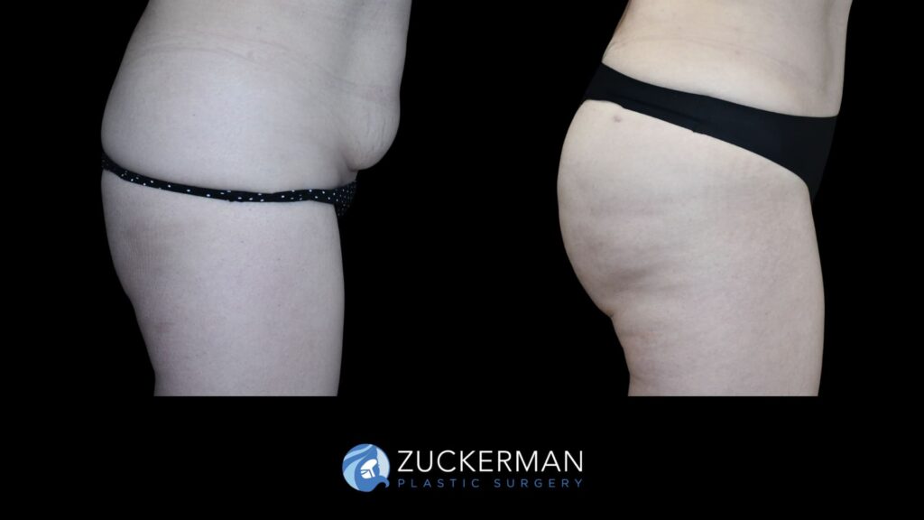 Patient results before and after tummy tuck performed by Dr. Zuckerman, showing a flatter and more toned abdominal area, front view, right view.