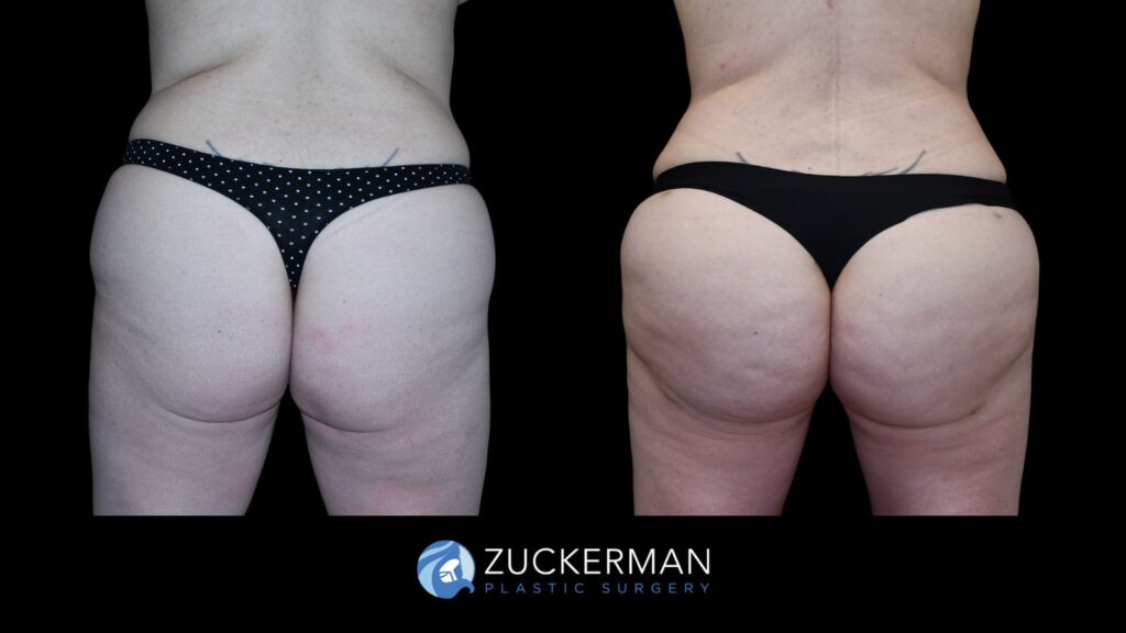 Patient results before and after Brazilian Butt Lift (BBL) performed by Dr. Zuckerman, showing improved contour and volume of the buttocks, back view.