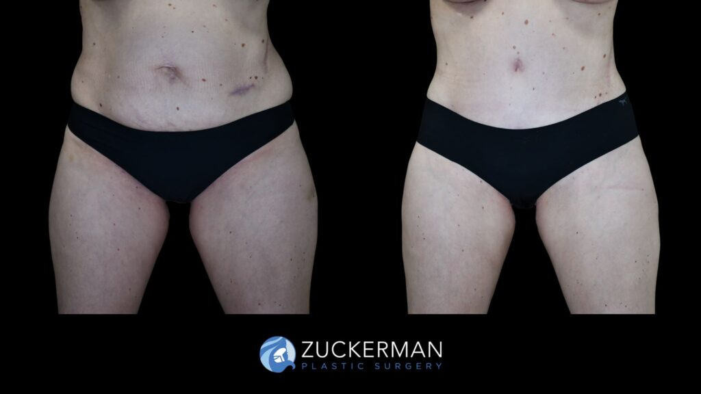 Patient results before and after tummy tuck performed by Dr. Zuckerman, showing a flatter and more toned abdominal area, front view.
