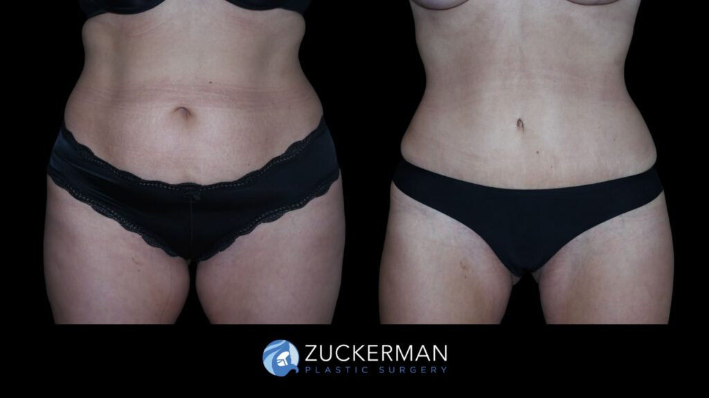 Patient results before and after tummy tuck performed by Dr. Zuckerman, showing a flatter and more toned abdominal area, front view.