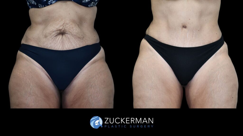 Patient results before and after tummy tuck performed by Dr. Zuckerman, showing a flatter and smoother abdominal area, front view.
