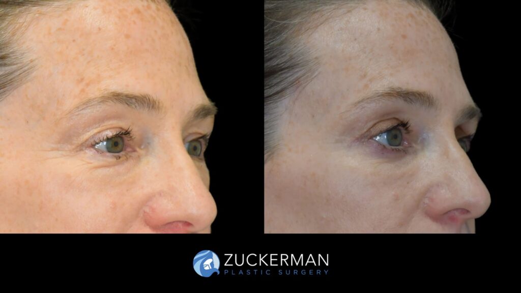 Patient results before and after upper blepharoplasty performed by Dr. Zuckerman, showing improved appearance of the upper eyelids, right oblique view.
