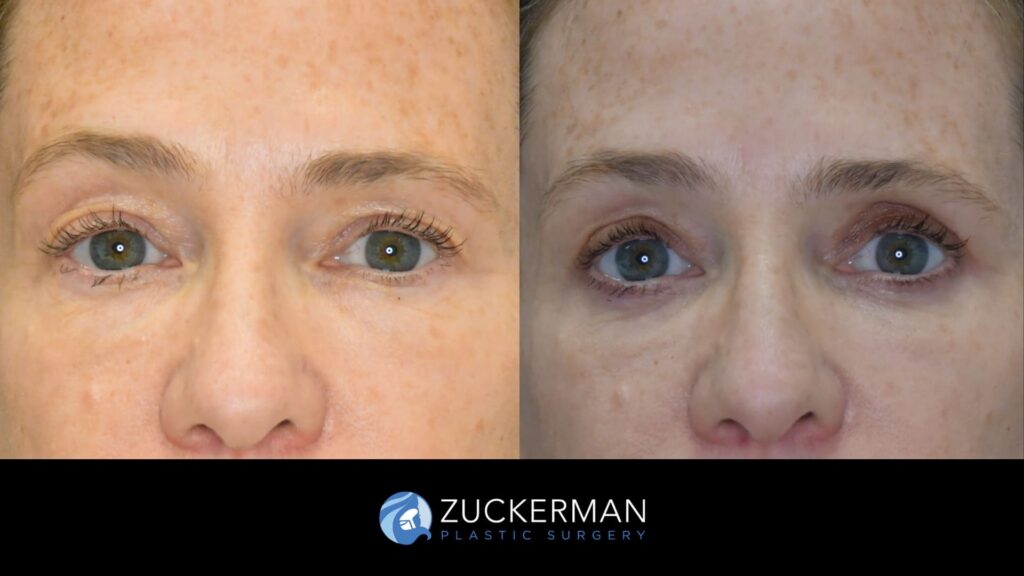 Patient results before and after upper blepharoplasty performed by Dr. Zuckerman, showing improved appearance of the upper eyelids, front view.