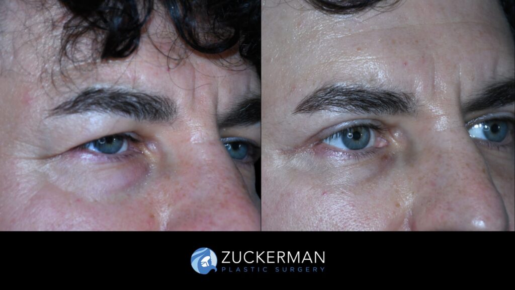 Patient results before and after upper and lower blepharoplasty performed by Dr. Zuckerman, male patient, showing improved appearance of the eyelids, right oblique view.