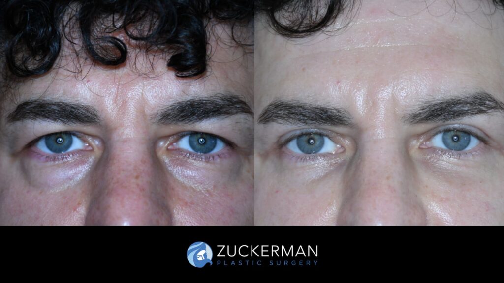 Patient results before and after upper and lower blepharoplasty performed by Dr. Zuckerman, male patient, showing improved appearance of the eyelids, front view.