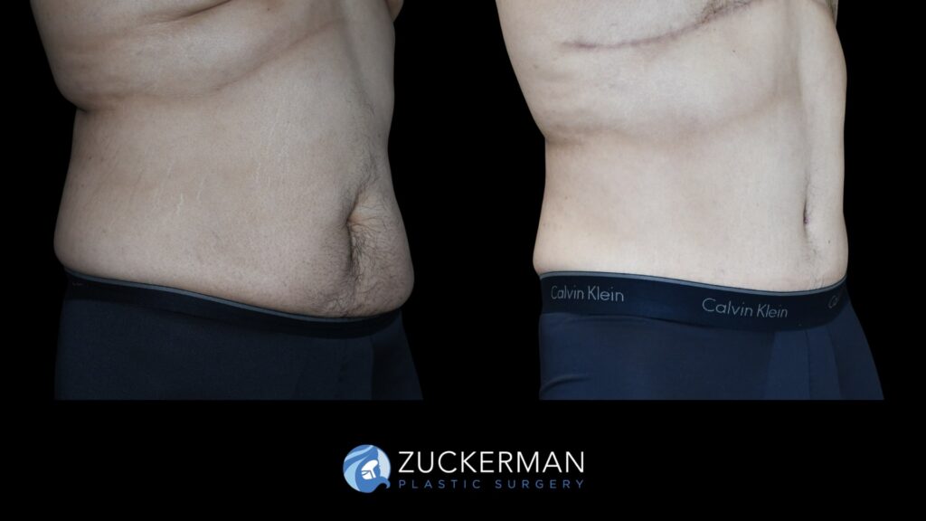 Patient results before and after male tummy tuck performed by Dr. Zuckerman, showing a flatter and more toned abdominal area, right oblique view.