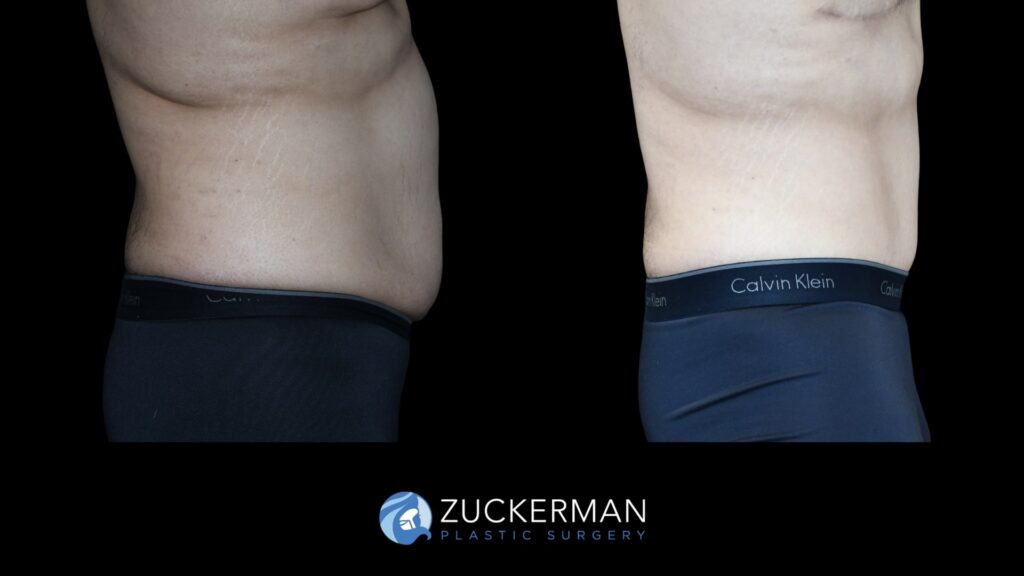 Patient results before and after male tummy tuck performed by Dr. Zuckerman, showing a flatter and more toned abdominal area, right view.