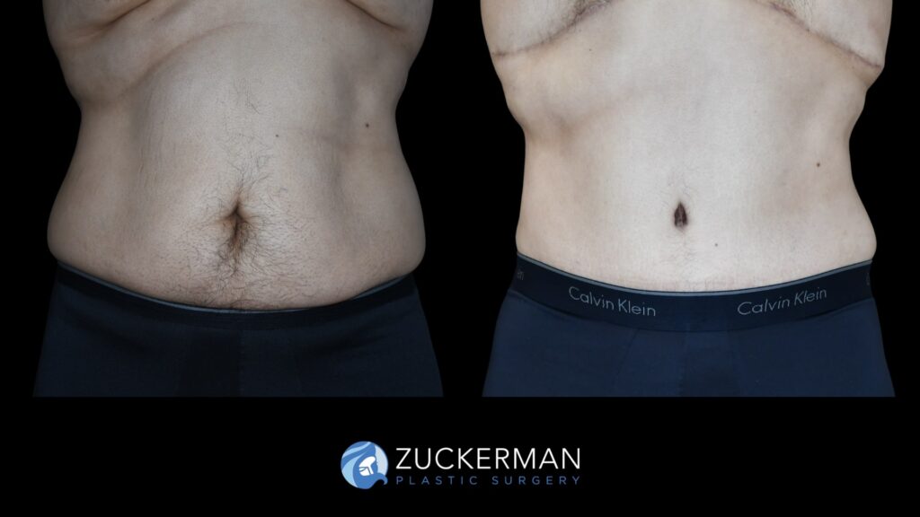 Patient results before and after male tummy tuck performed by Dr. Zuckerman, showing a flatter and more toned abdominal area, front view.