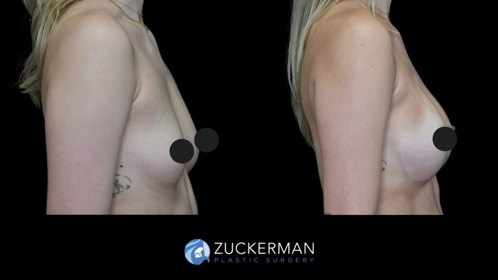 Patient results before and after breast augmentation performed by Dr. Zuckerman, showing enhanced breast shape and volume, right view.