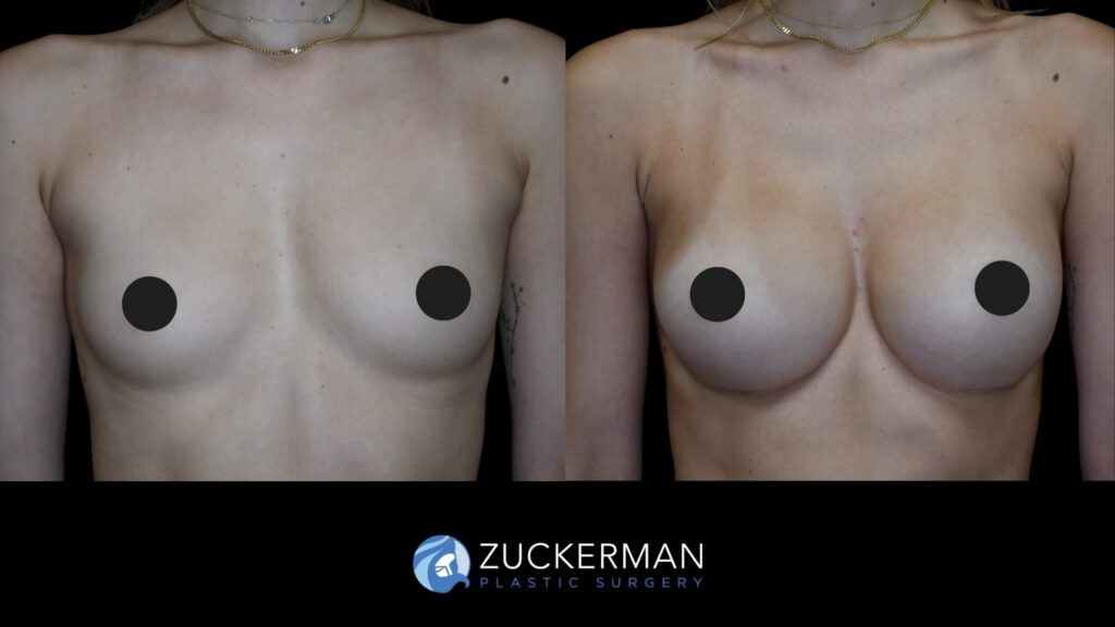 Patient results before and after breast augmentation performed by Dr. Zuckerman, showing enhanced breast shape and volume, front view.