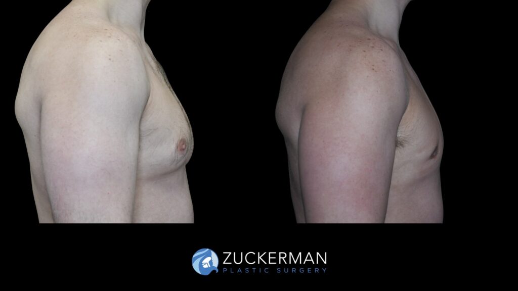 ale breast reduction (Gynecomastia correction surgery) by Dr. Zuckerman