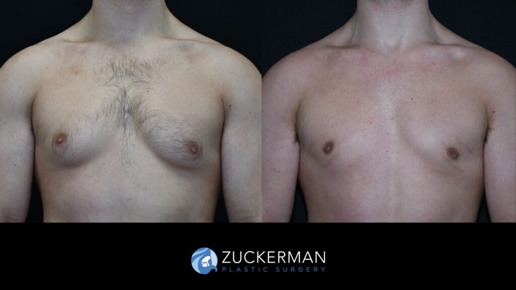 ale breast reduction (Gynecomastia correction surgery) by Dr. Zuckerman