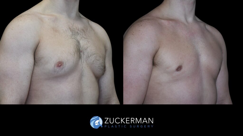 ale breast reduction (Gynecomastia correction surgery) by Dr. Zuckerman