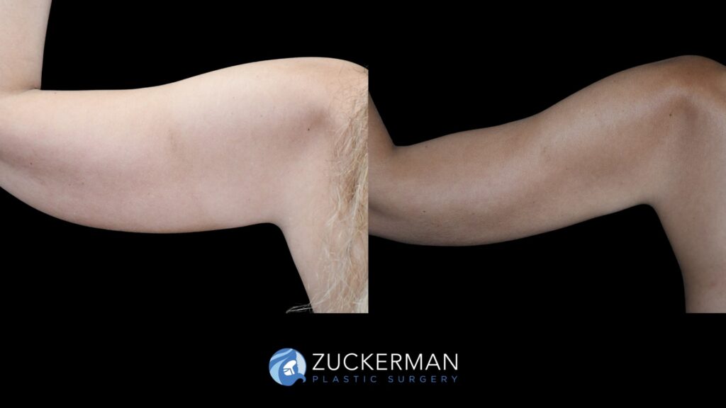 Before and after Liposuction (Armi Lift) by Dr. Zuckerman.