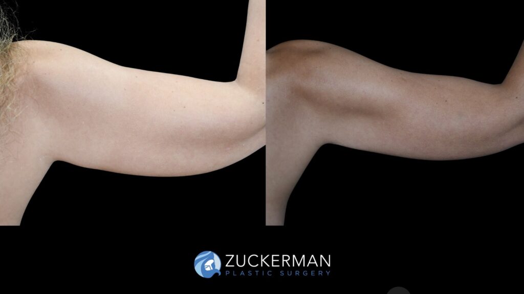 Before and after Liposuction (Armi Lift) by Dr. Zuckerman.