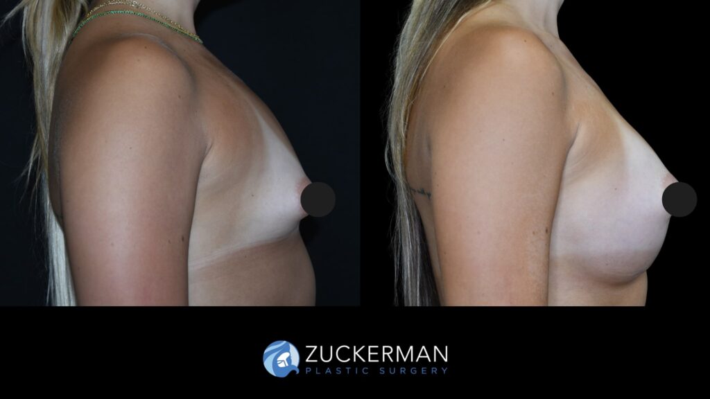 Patient results before and after breast augmentation performed by Dr. Zuckerman, showing enhanced breast shape and volume, right view.