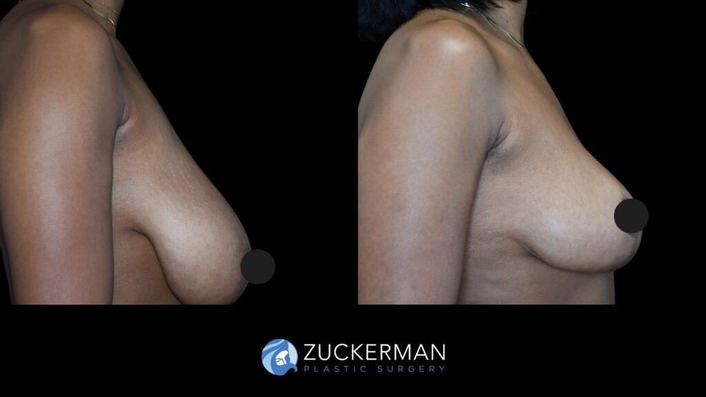 Patient before and after Breast Reduction | Zuckerman Plastic Surgery
