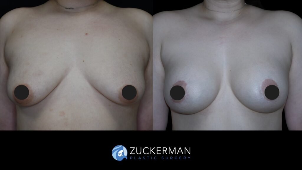 Patient results before and after breast augmentation and lift (augmentation pexy) performed by Dr. Zuckerman, showing enhanced shape and volume of the breasts, front view.